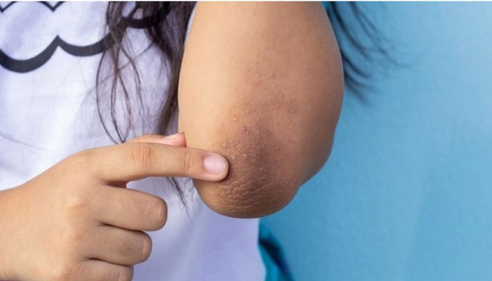 যেভাবে দূর করবেন কনুই হাঁটুর কালো দাগ